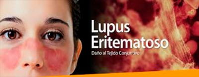 sl-reumatologia-lupus